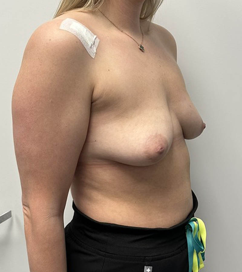 Breast Augmentation case #5026