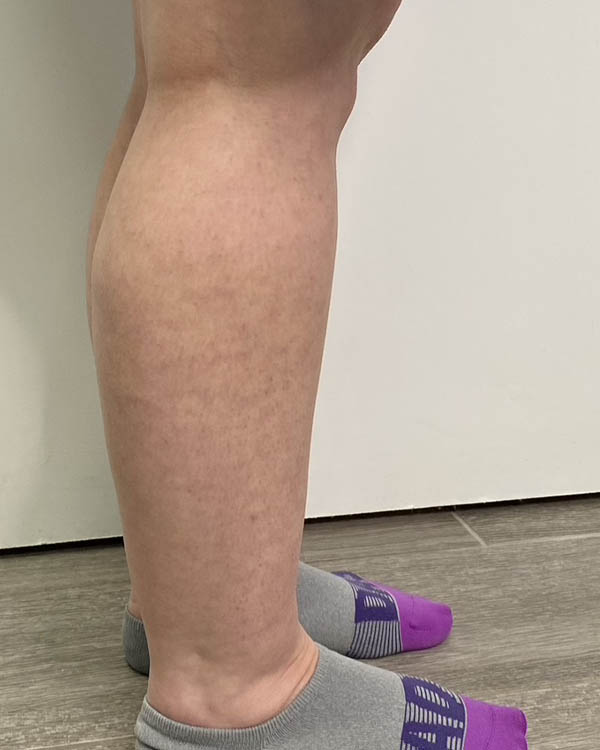 Liposuction case #5178