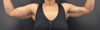Arm Lift case #5010