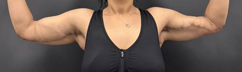 Arm Lift case #5010