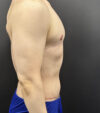 Gynecomastia case #5085