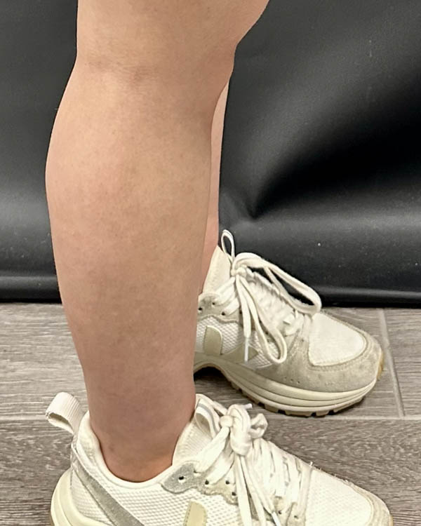 Liposuction case #5178