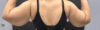 Arm Lift case #5010