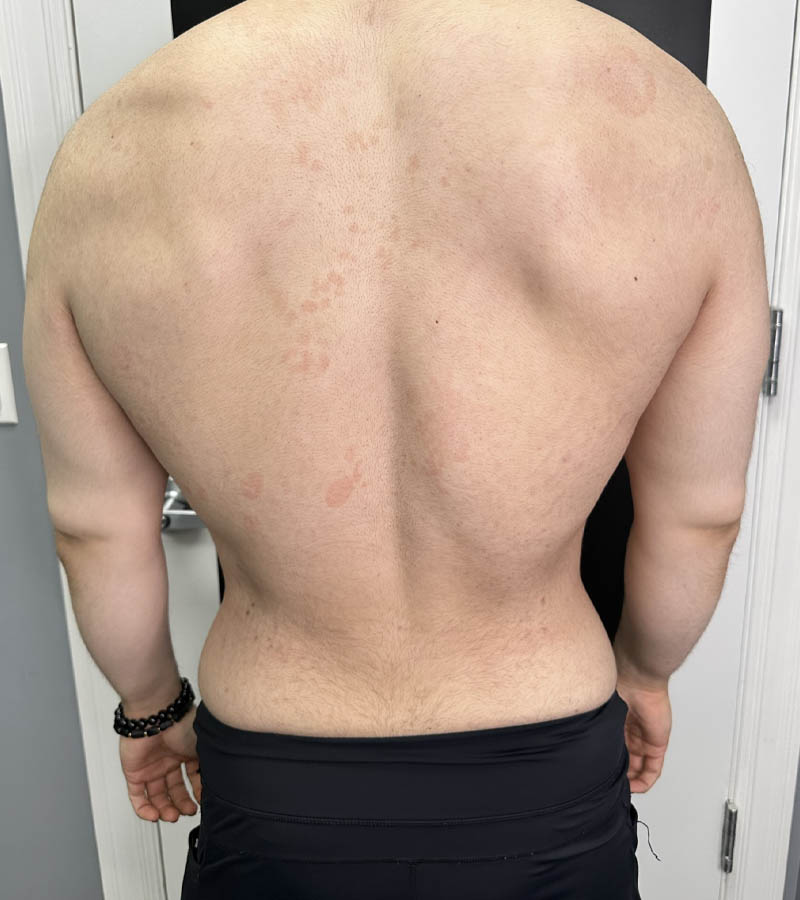 Gynecomastia case #5085