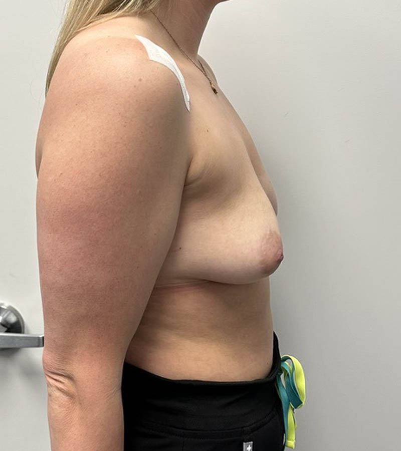 Breast Augmentation case #5026