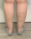 Liposuction case #5178