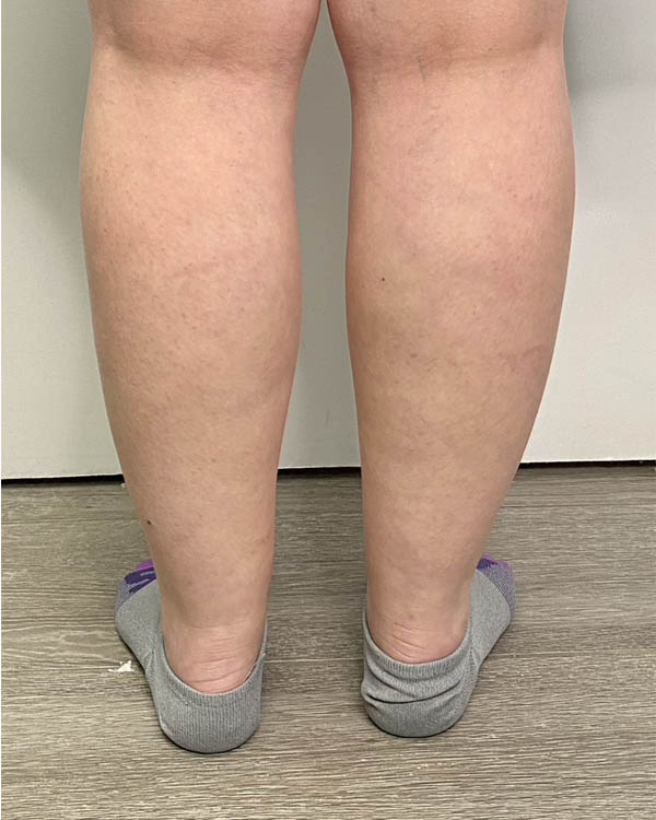 Liposuction case #5178
