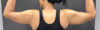 Arm Lift case #5010