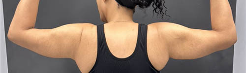 Arm Lift case #5010