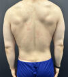 Gynecomastia case #5085