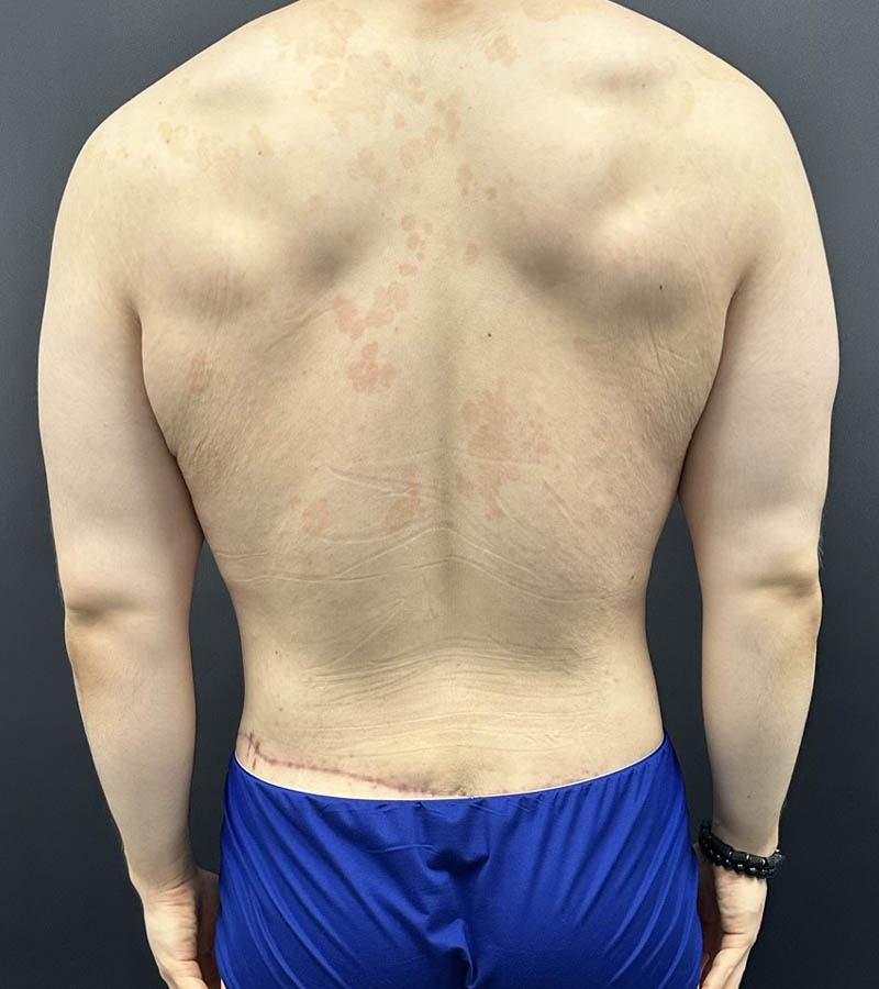 Gynecomastia case #5085