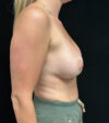 Breast Augmentation case #5026