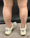 Liposuction case #5178