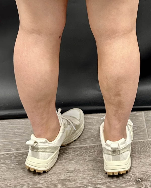 Liposuction case #5178