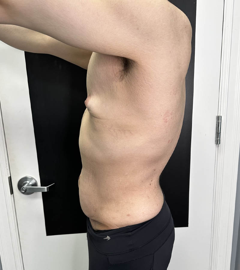 Gynecomastia case #5085