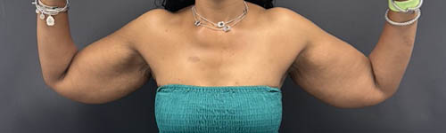 Arm Lift case #5018