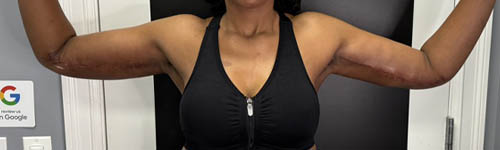 Arm Lift case #5018