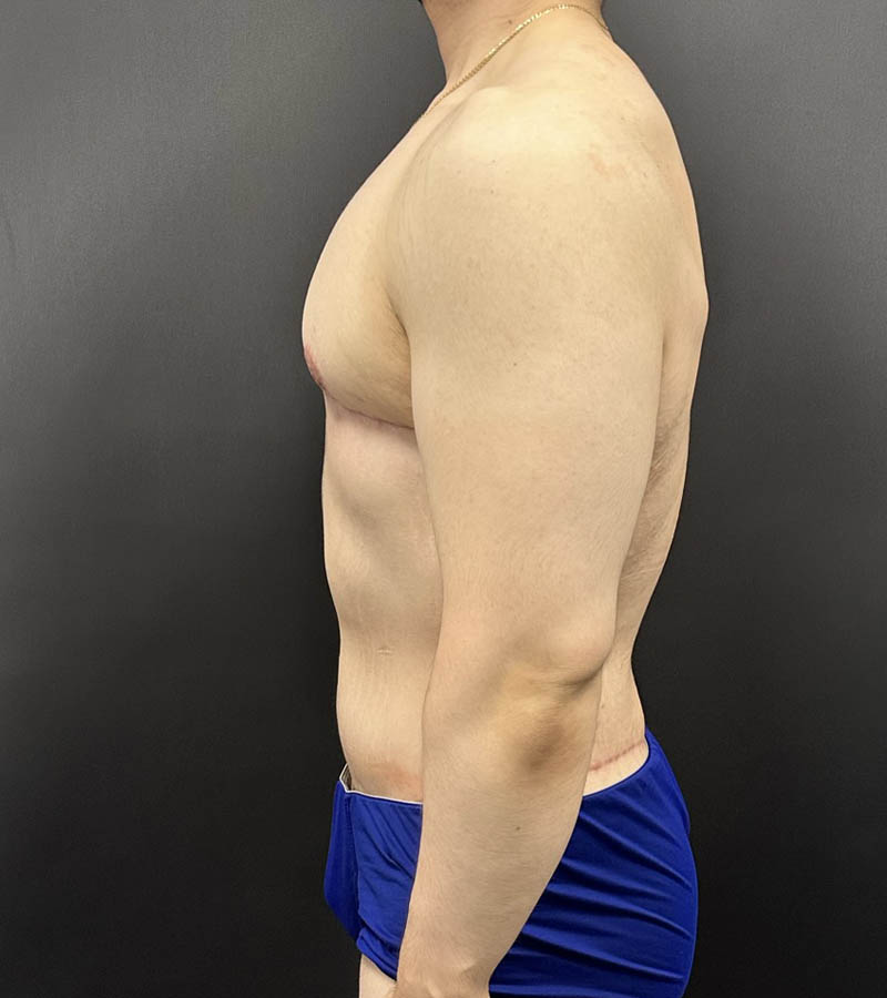 Gynecomastia case #5085