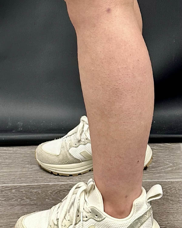 Liposuction case #5178
