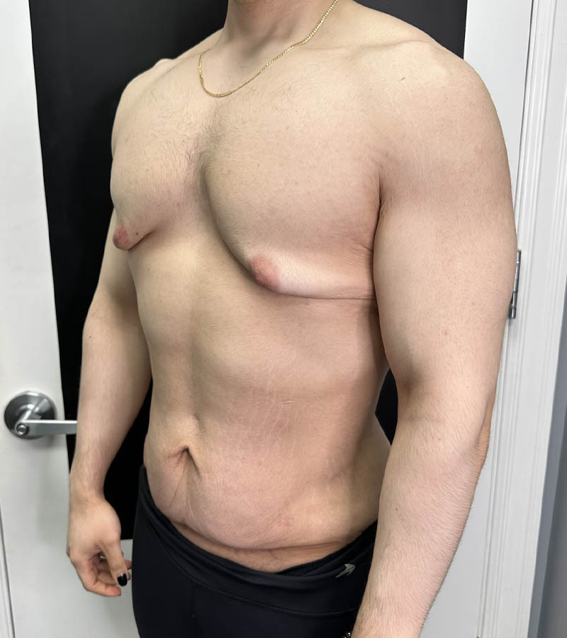 Gynecomastia case #5085