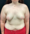 Breast Augmentation case #5040