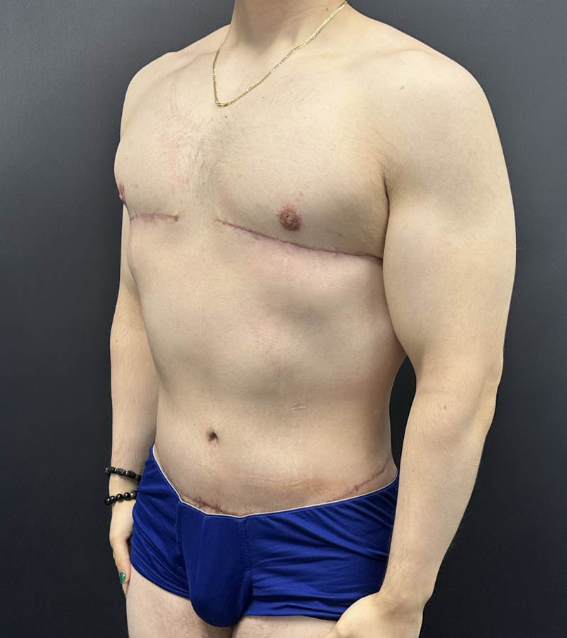 Gynecomastia case #5085