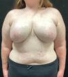 Breast Augmentation case #5040