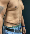 Gynecomastia case #5101
