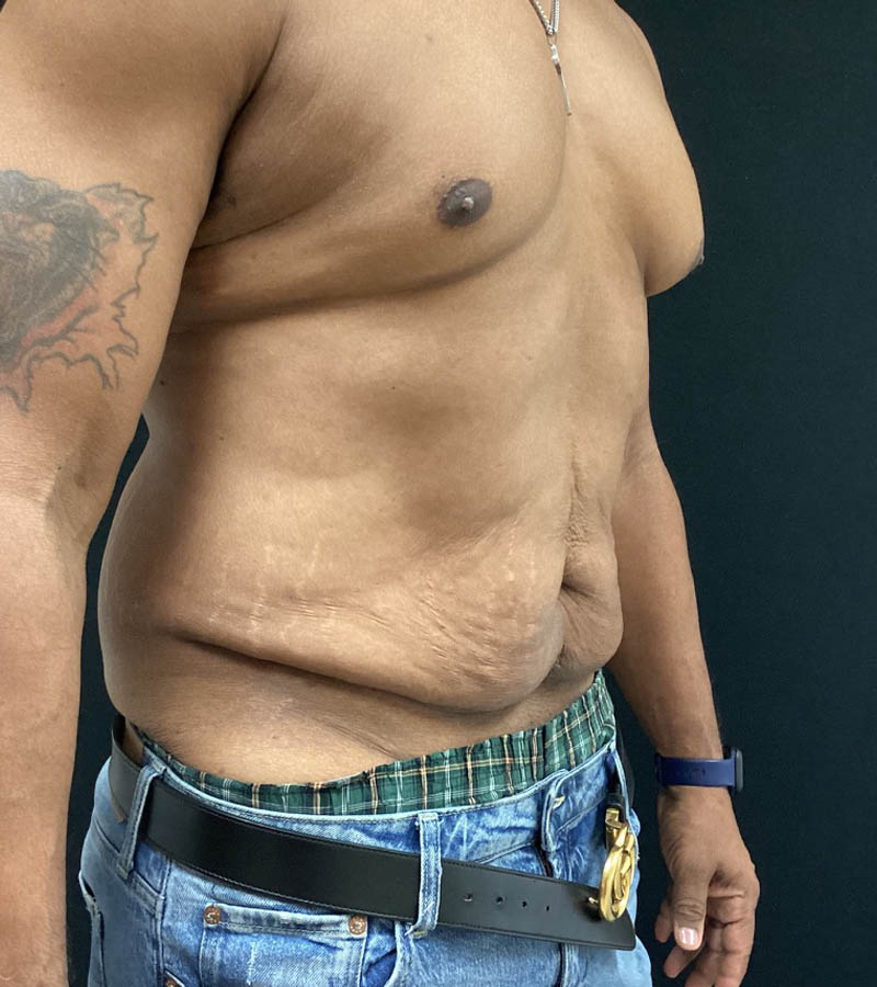 Gynecomastia case #5101
