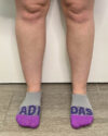 Liposuction case #5178
