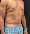 Gynecomastia case #5101