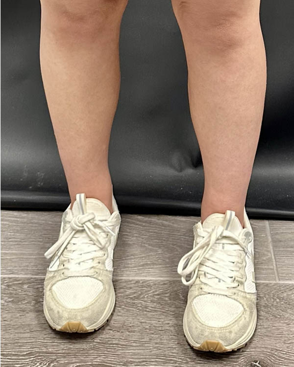 Liposuction case #5178