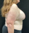 Breast Augmentation case #5040