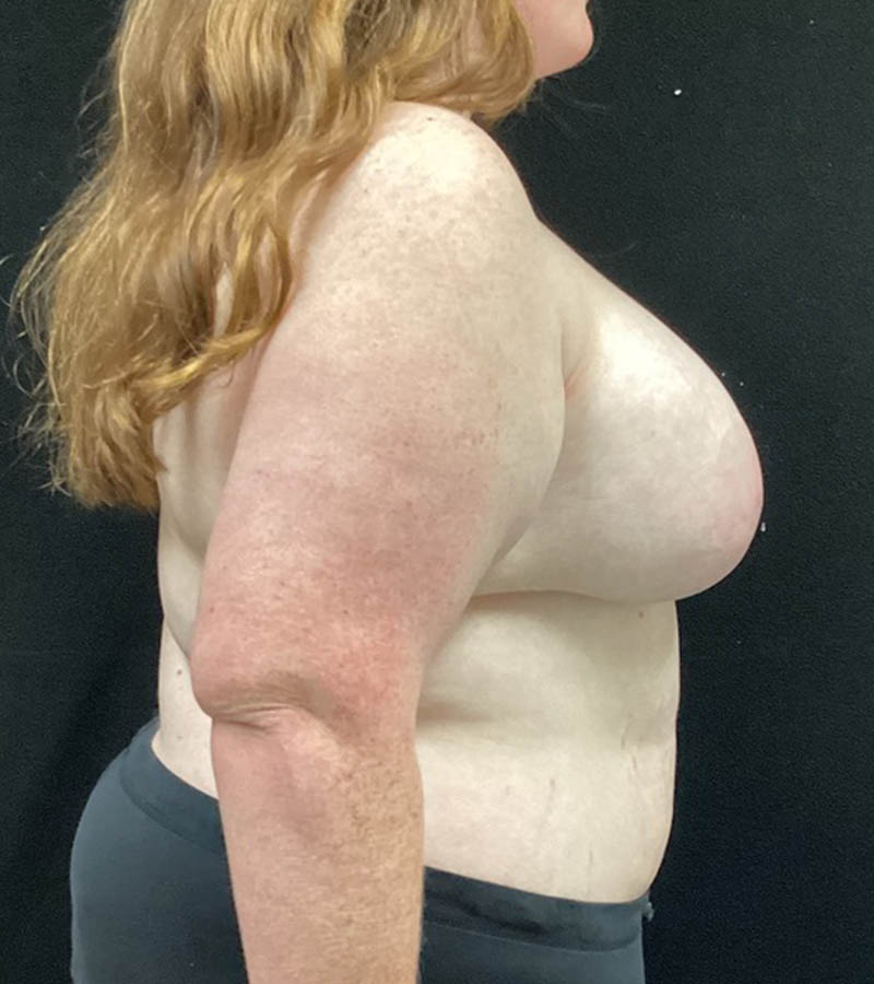 Breast Augmentation case #5040
