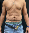 Gynecomastia case #5101