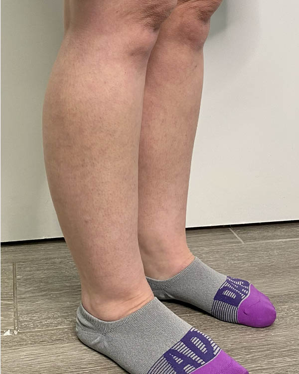 Liposuction case #5178