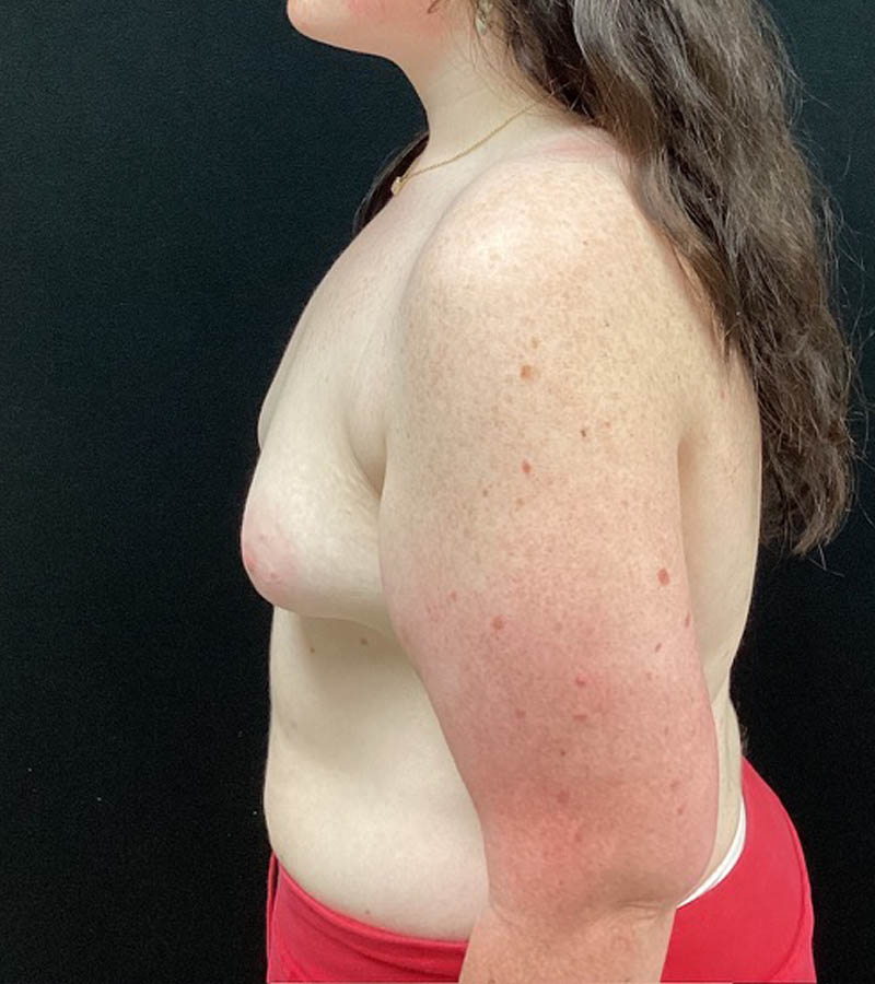 Breast Augmentation case #5040