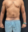 Gynecomastia case #5101