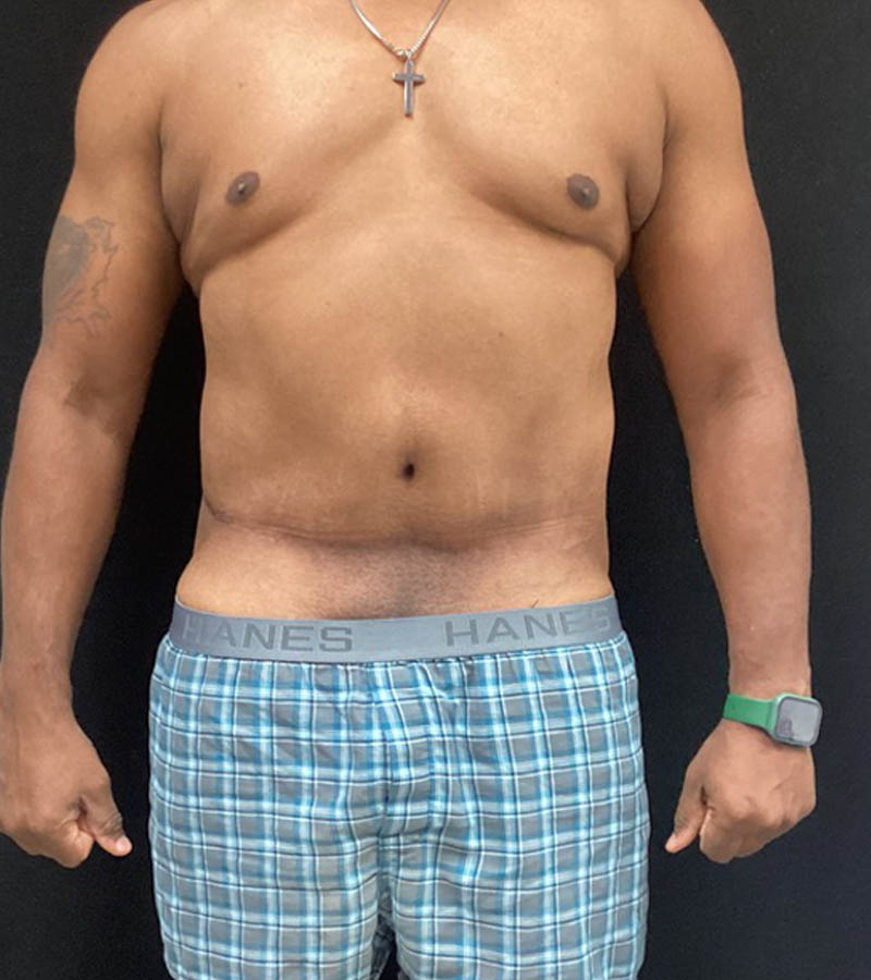Gynecomastia case #5101