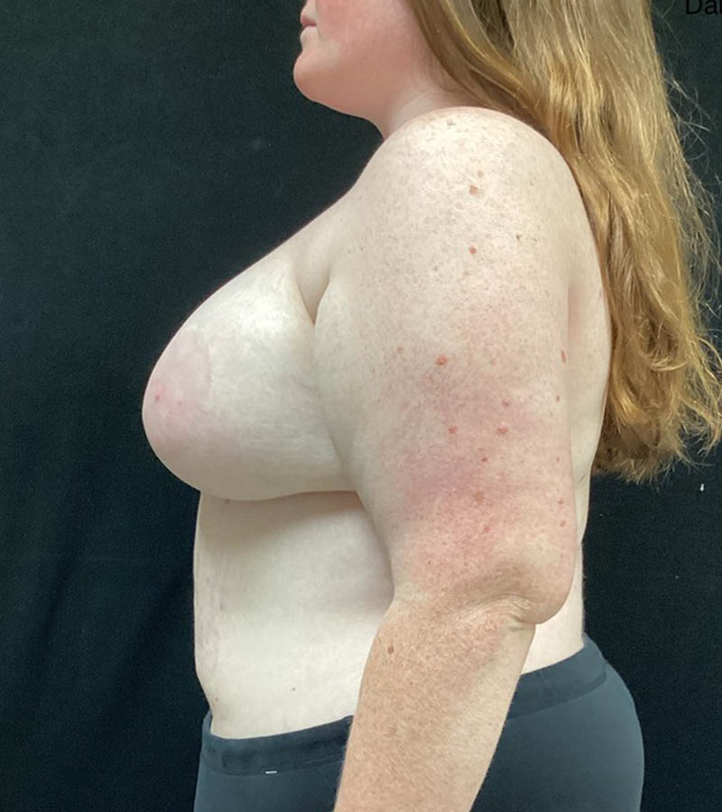 Breast Augmentation case #5040