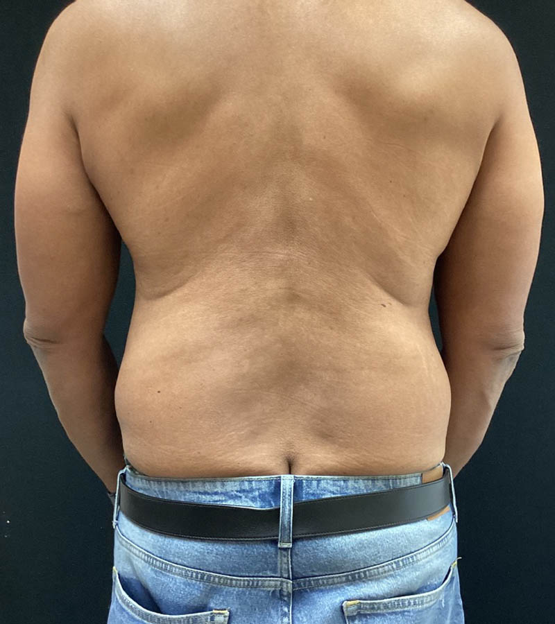 Gynecomastia case #5101
