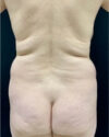 Liposuction case #5194