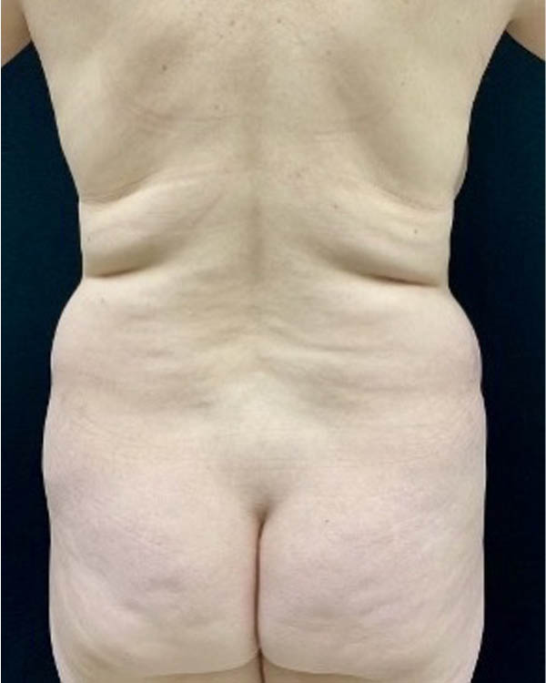 Liposuction case #5194