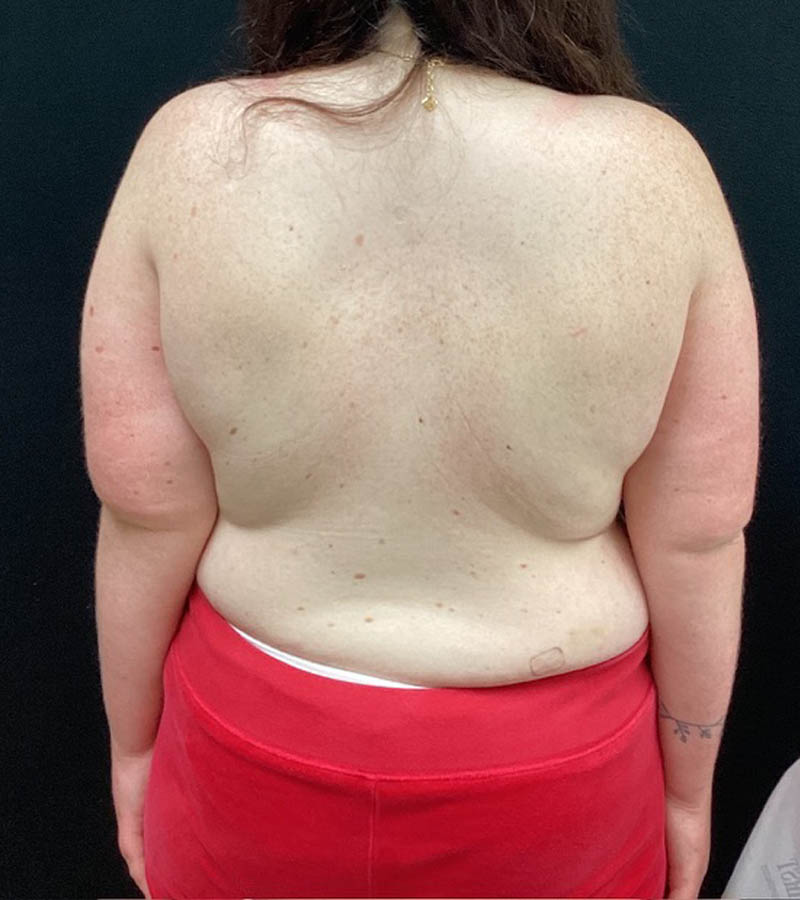 Breast Augmentation case #5040