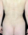 Liposuction case #5194