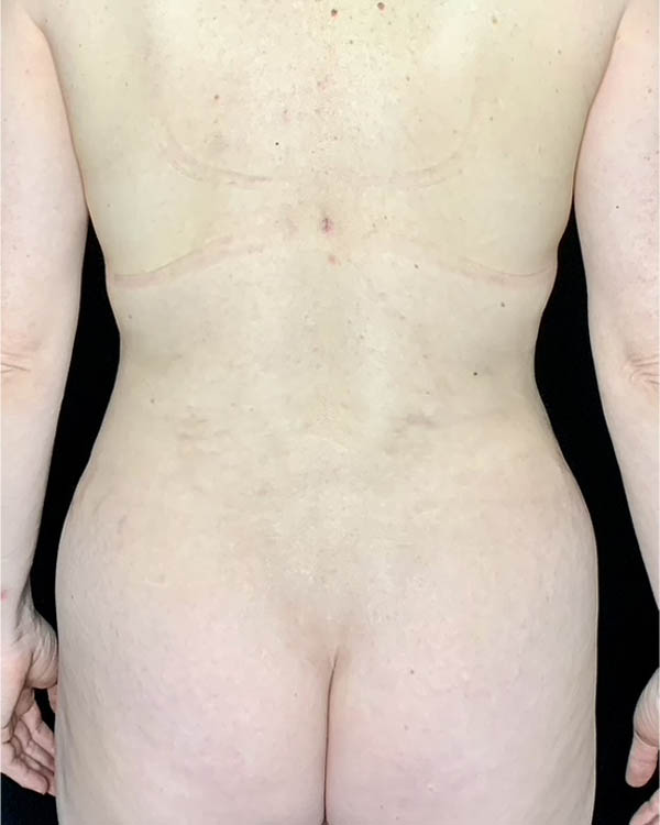 Liposuction case #5194