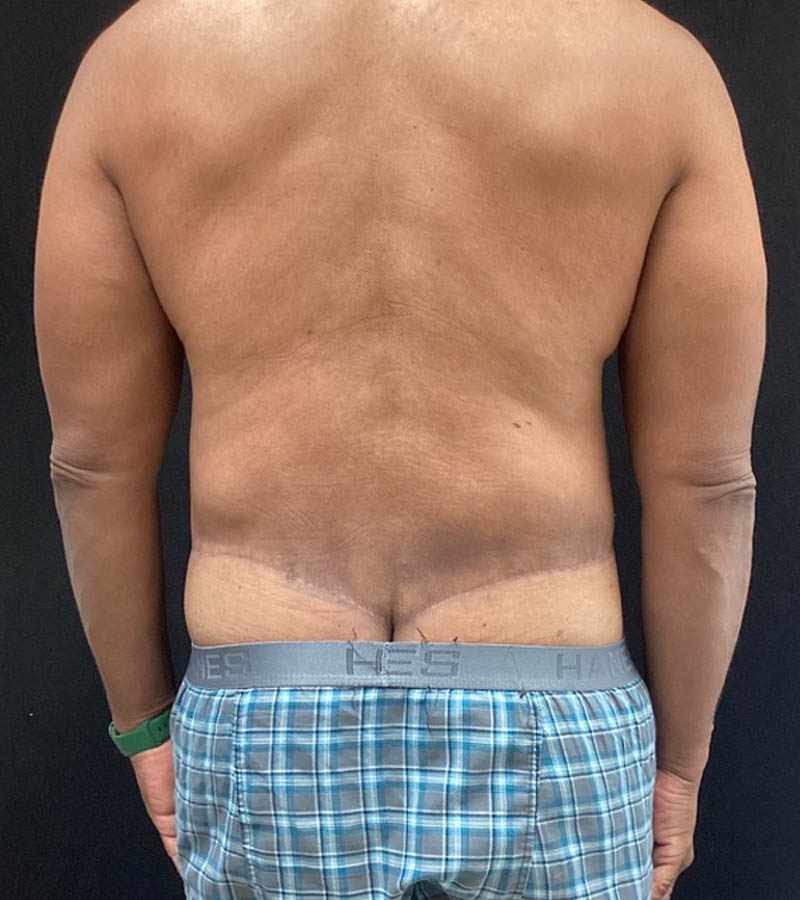 Gynecomastia case #5101