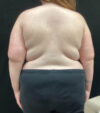 Breast Augmentation case #5040