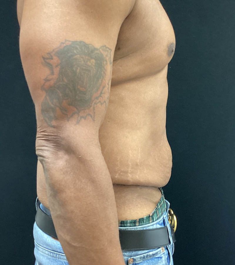 Gynecomastia case #5101