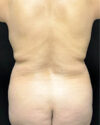Liposuction case #5212